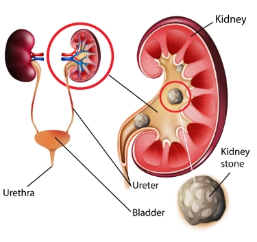 Kidneystone